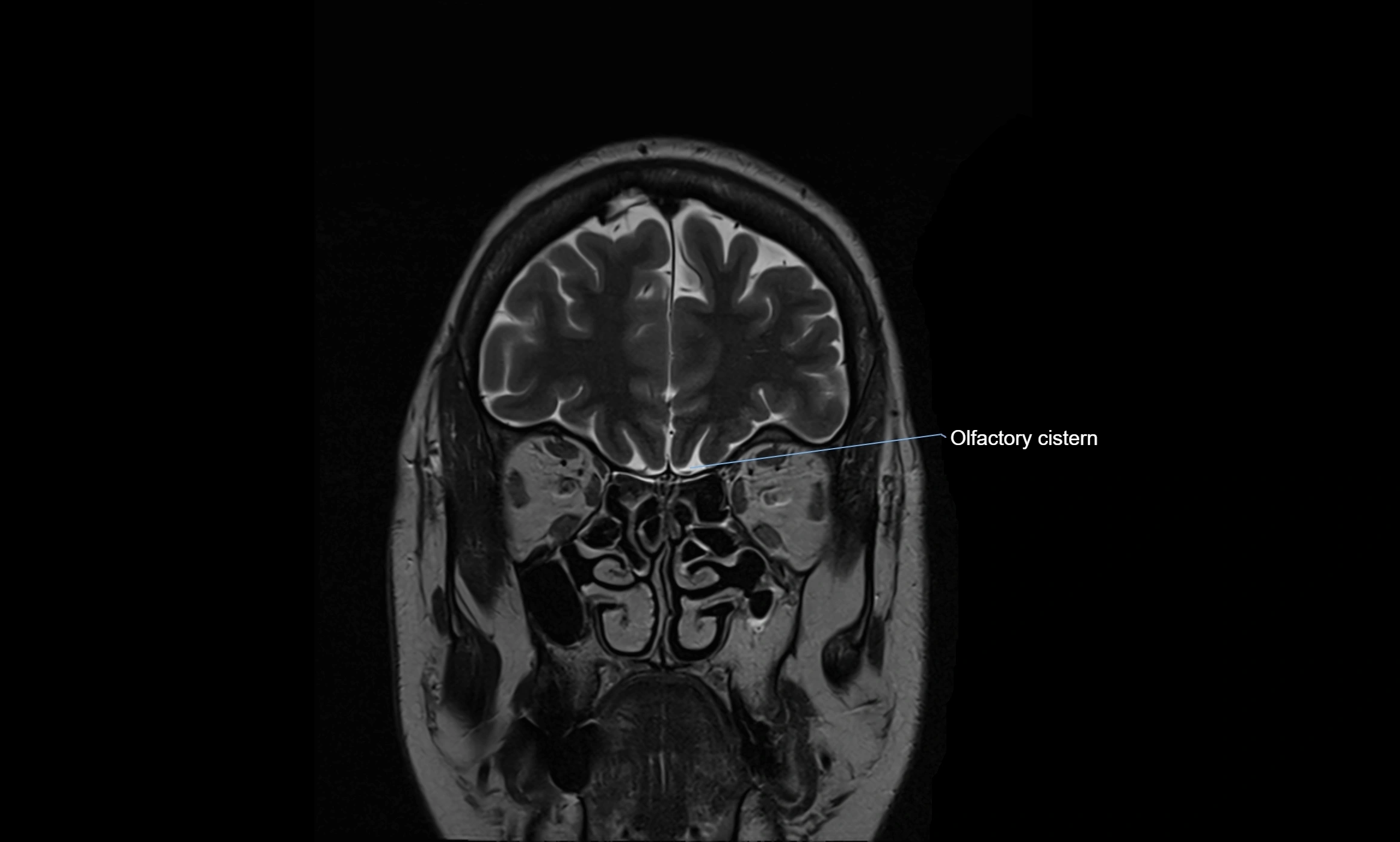 Brain cisterns  and ventricles coronal anatomy 3T MRI image-img-00001-00007.webp